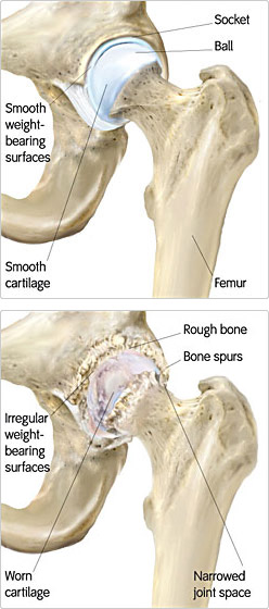 Causes of Arthritis - Portland Hip Resurfacing - The Next ... femoral diagram 